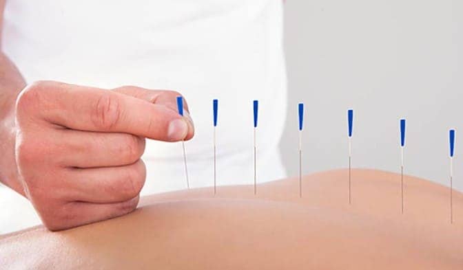 Tratamiento punción seca Fisioterapia